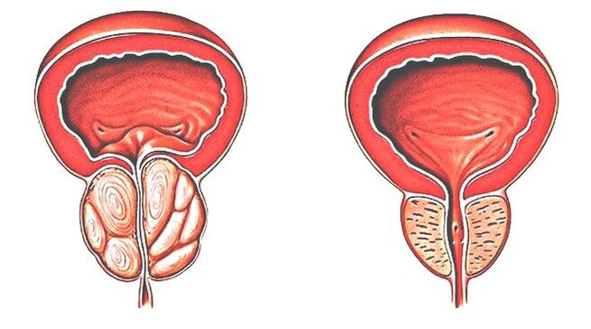 Prostatitis and normal prostate