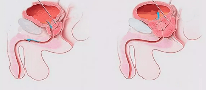 A sign of prostatitis in men