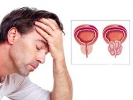 Prostatitis on a man