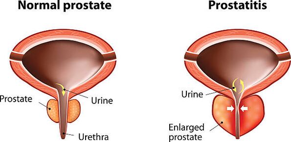 normal prostate and inflammation