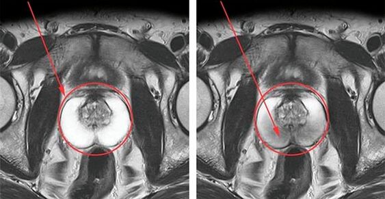 Normal prostate (left) and prostate inflammation with prostatitis (right)